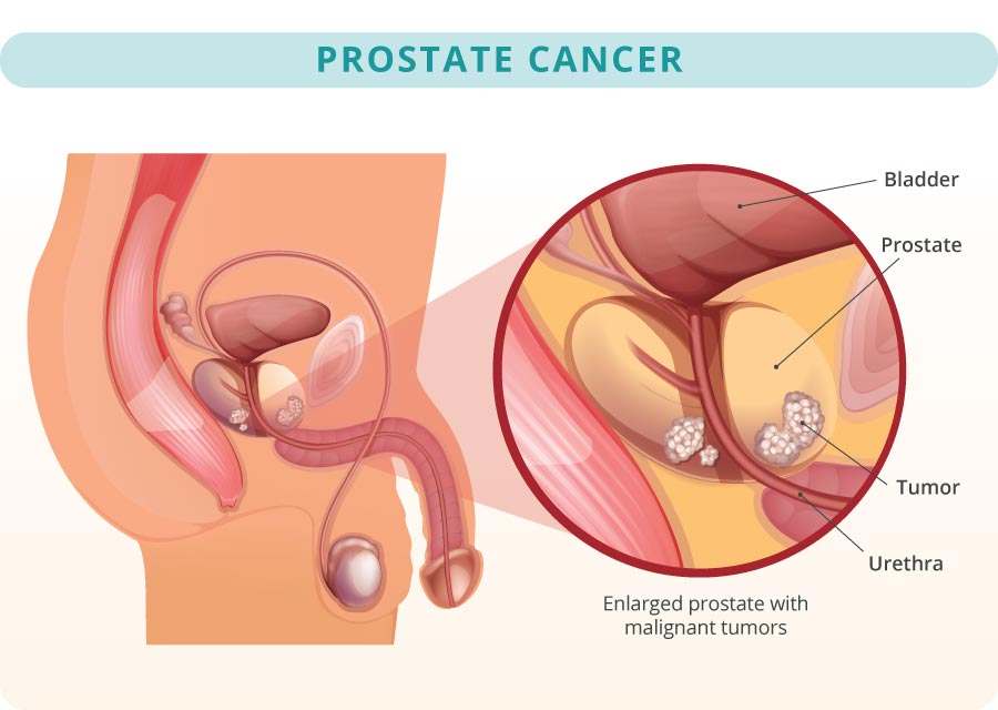 Prostate Cancer Illustration with labeled bladder, prostate, tumor, and urethra.