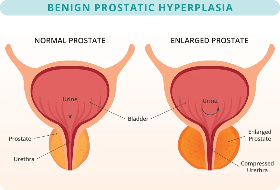 Enlarged Prostate Illustration showing normal and enlarged prostates, regarding BPH